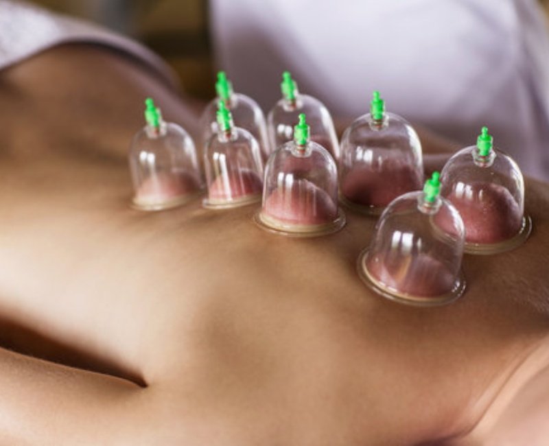 16554-cupping-therapy (2)