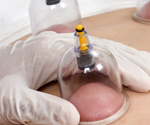 cupping-therapy-500x500-1